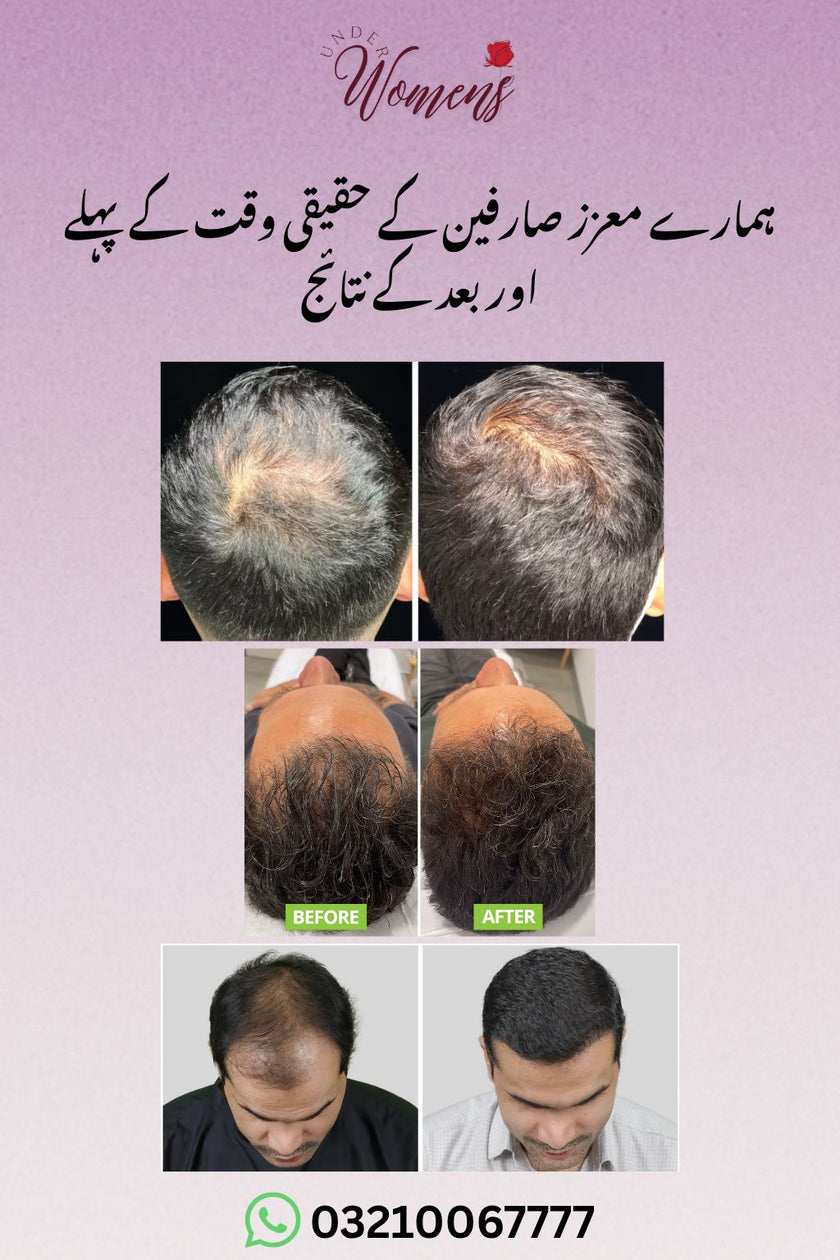 Hair Growth And Anti Dandruff Hair Oil